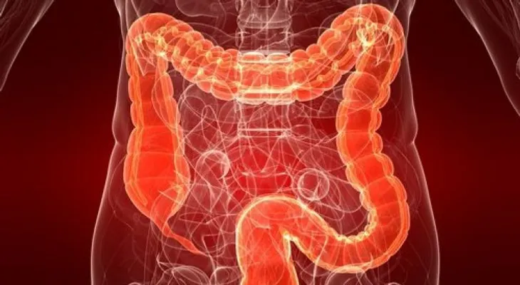 Colitis ulcerosa: una enfermedad desconocida