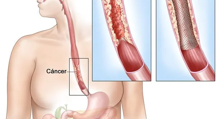  El abuso del consumo de carnes rojas y tomar bebidas muy calientes (té o café), son factores de altos riesgos del cáncer de esófago