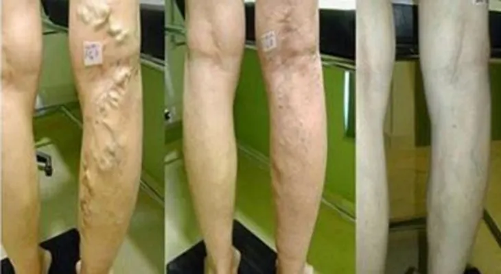 Sana tus venas varicosas con Aloe, Zanahoria y Vinagre de Manzana 
