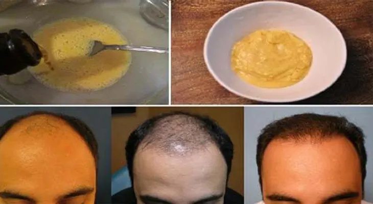Mezcló banana (guineo) y cerveza y lo aplicó al pelo durante 7 días. Resultados imperdibles. 