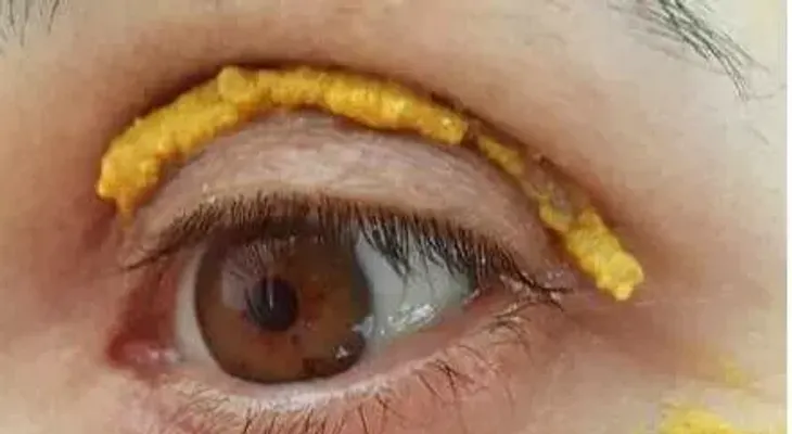 Si tienes ojeras, esta es la solución pefecta. Funciona en mujeres y hombres