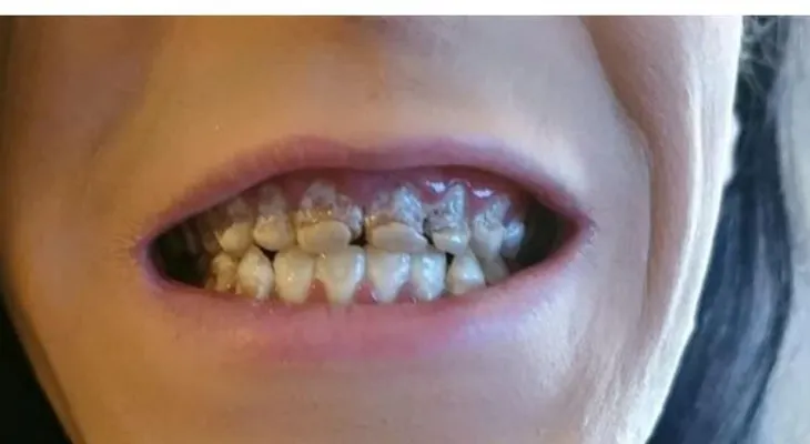 Joven británico perdió su dentadura tras ingerir bebidas energizantes