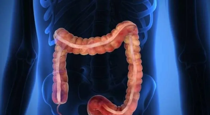 5 puntos acerca del cáncer colorrectal   