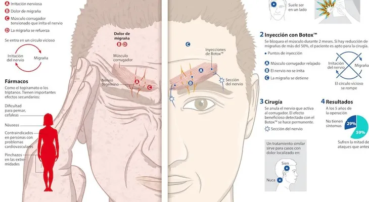 Migraña crónica, más de 800 mil afectados: La mitad de los pacientes se automedican sin receta