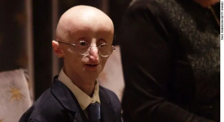 Muere a los 17 años joven con rara enfermedad de envejecimiento