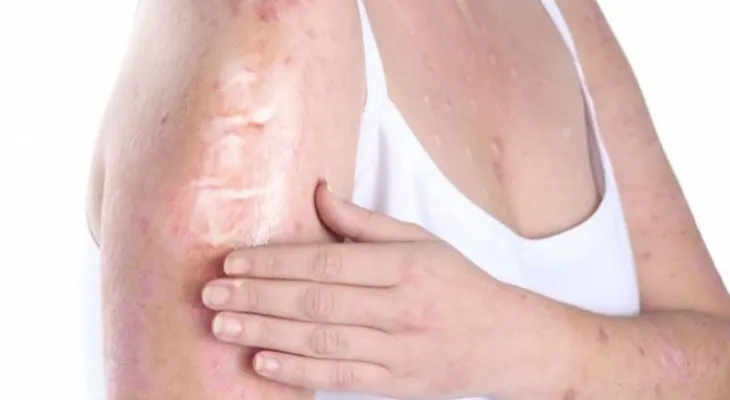 Psoriasis: El aislamiento y el estrés agravan las lesiones