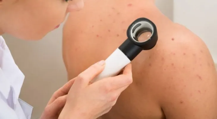 Cerca 3% población mundial tiene Psoriasis