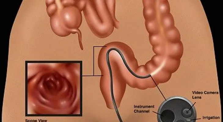 4 tips para prevenir el cáncer de colon