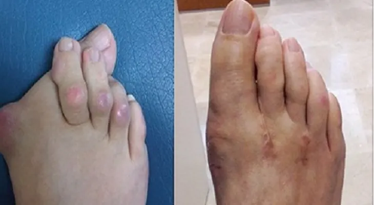 Los médicos dicen que esto es verdad: Di adiós a la artritis con este último remedio!?