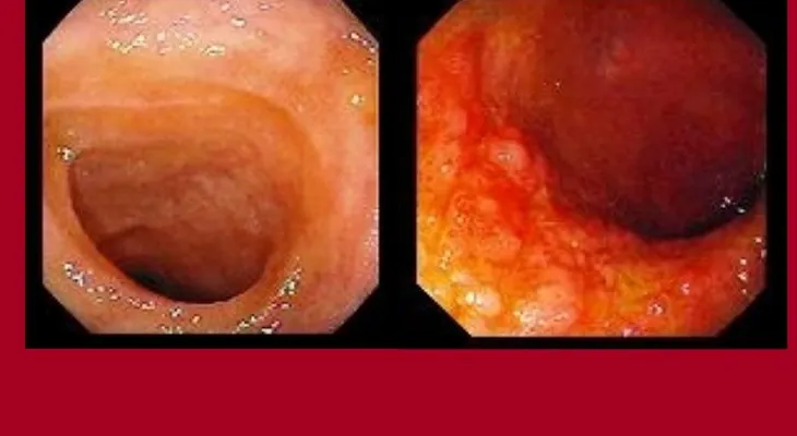 Hallan una forma más efectiva para tratar enfermedad de Crohn