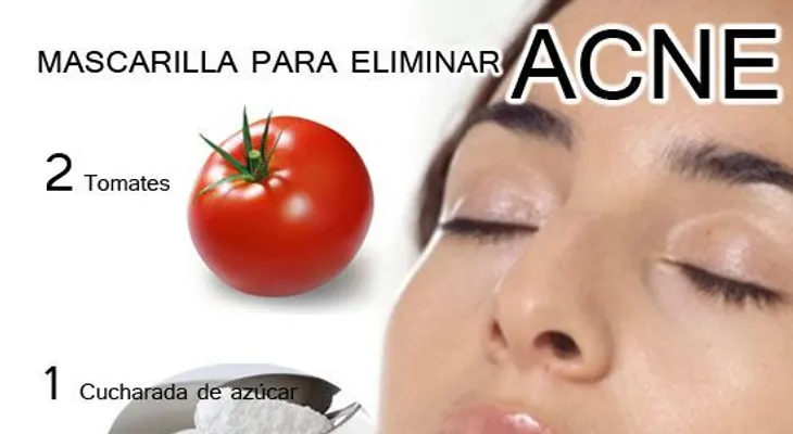 Los tomates curan el acné