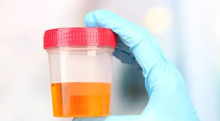Orinar espumoso puede ser síntoma de una patología renal