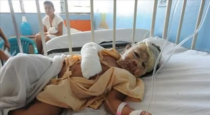 Dos niñas resultan con quemaduras al incendiarse su casa en Cabarete