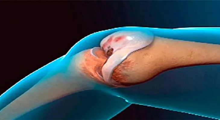 Doctores no lo pueden creer: Receta Renueva las Rodillas y Articulaciones Naturalmente