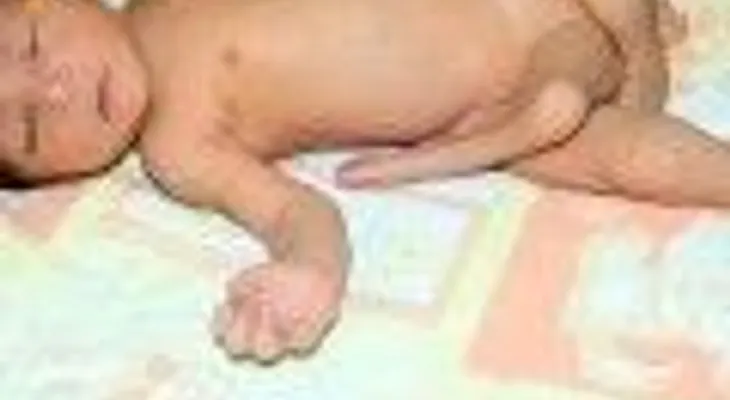 Nace bebe con seis piernas en Pakistán