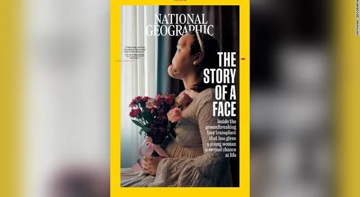 Le hacen un histórico trasplante de rostro a una adolescente que intentó suicidarse 