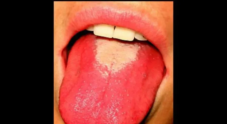 10 enfermedades que puedes adquirir con un beso