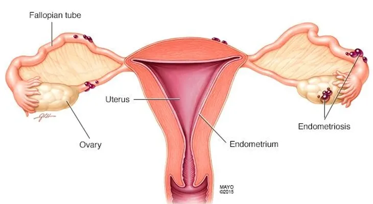 Endometriosis: Una infección que afecta ovarios, trompas de Falopio y pelvis de la mujer