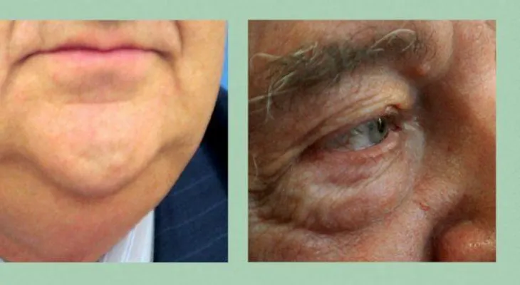 Papada y bolsas de ojos, principales complejos en los hombres