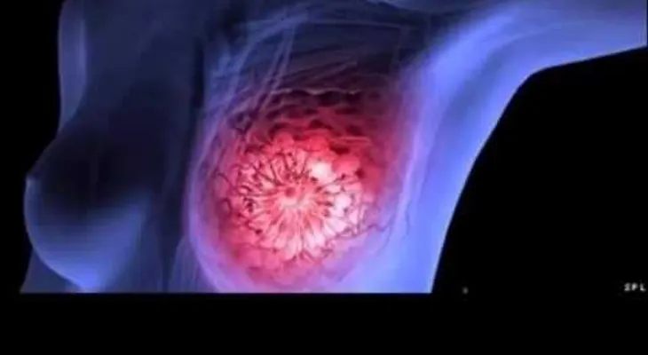 Descubran causa del cáncer de senos, y lo tomamos a diario (VIDEO)