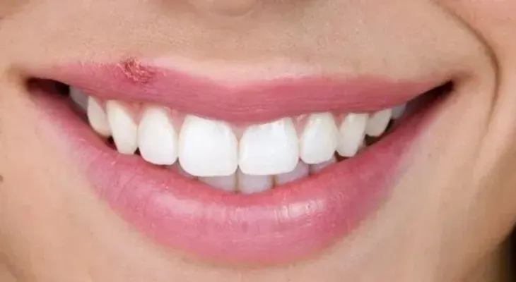 Cómo evitar y tratar el herpes labial