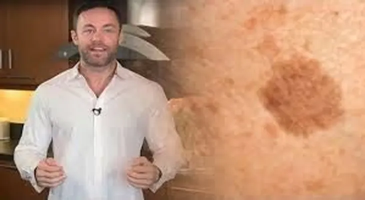 Famoso dermatólogo revela cómo quitar los puntos marrones de la cara y la piel con este simple truco