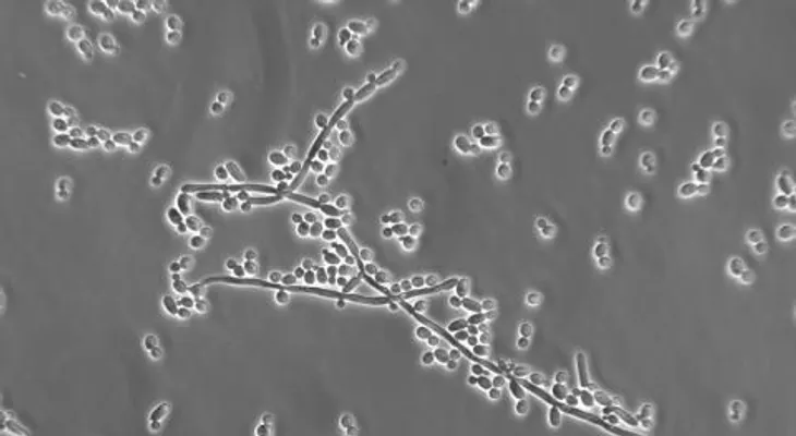 Las candidiasis son infecciones agudas o crónicas de la piel; cómo prevenirla