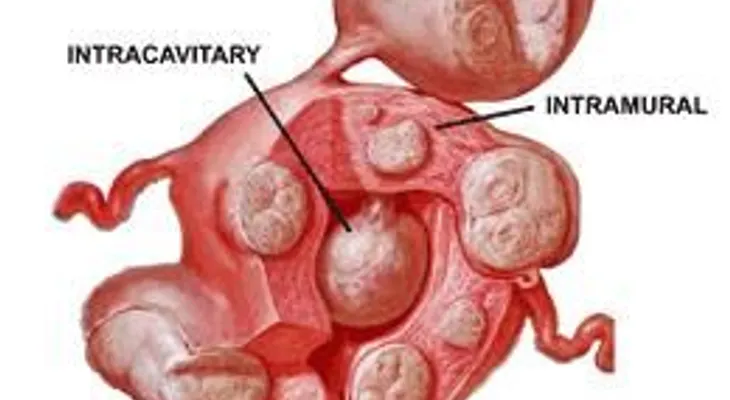 Mioma; síntoma; causa y tratamiento