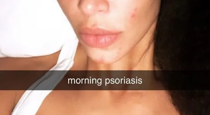 Kim Kardashian deja al descubierto marcas en su piel por enfermedad incurable 
