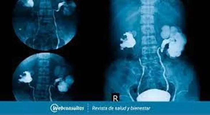 Urografía excretora: Un examen para detectar sangre en la orina, piedras en los riñones o vejiga y cáncer en el tracto urinario