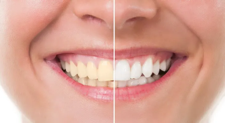 Blanqueamiento dental en sólo 3 minutos 