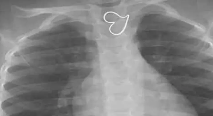 Doctores están atónitos por insólito caso de niña con dos corazones en el pecho