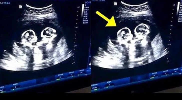 Gemelas se "pelean" en el útero de su madre; capta una ecografía 