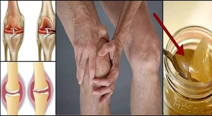 La raiz del dolor de rodilla es un daño del cartilago, por lo que esta es la forma de regenerarlo naturalmente
