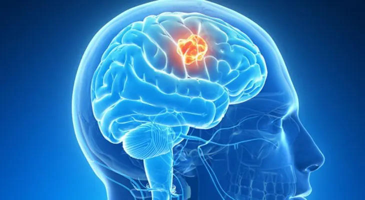  Nuevo descubrimiento terapéutico contra el glioblastoma, de los tumores más letales 