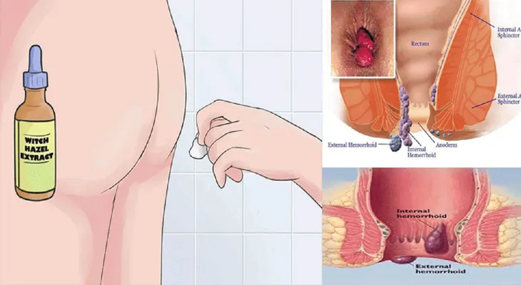 Los doctores aun no encuentran la explicación de porqué esto corta la hemorroide en 20 minutos!!!