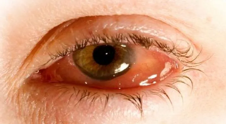 La higiene es vital para la salud ocular