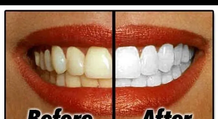 Para blanquear tus dientes en minutos 