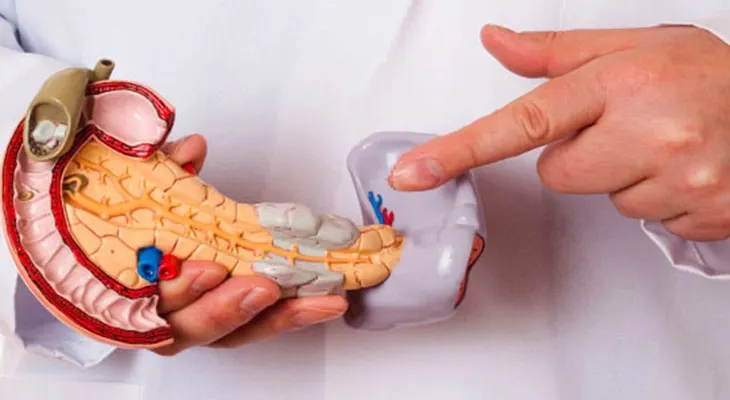 El cáncer de páncreas se ha convertido en el asesino silencioso