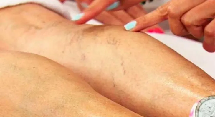 Increibles remedios para quitar las arañitas o varices de las piernas