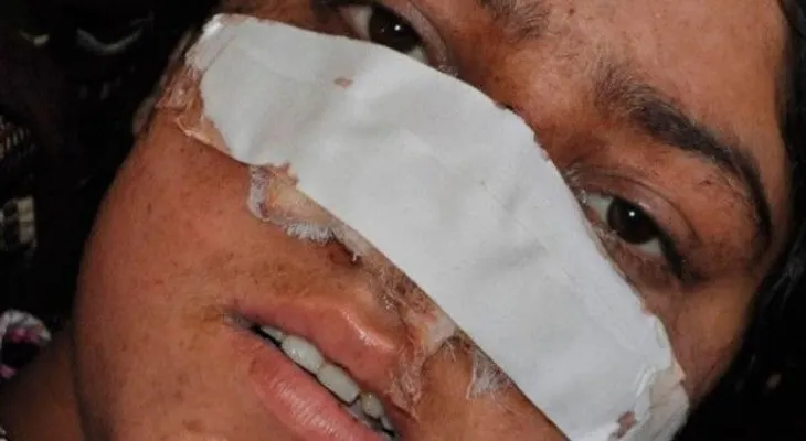 Hombre le corta la nariz a su esposa 
