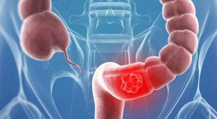 El cáncer neuroendocrino puede surgir en cualquier parte del cuerpo