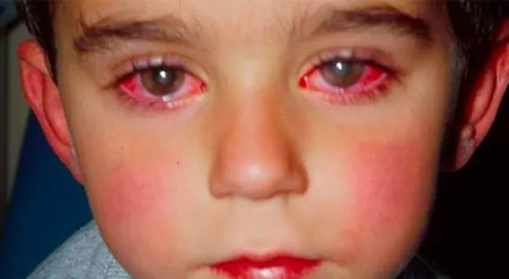 Este niño perdió el 75% de su vista por un juguete que había en la casa