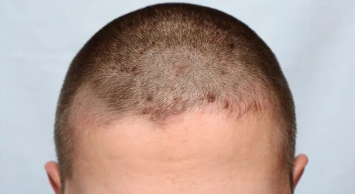 Tratamientos naturales para la dermatitis seborreica