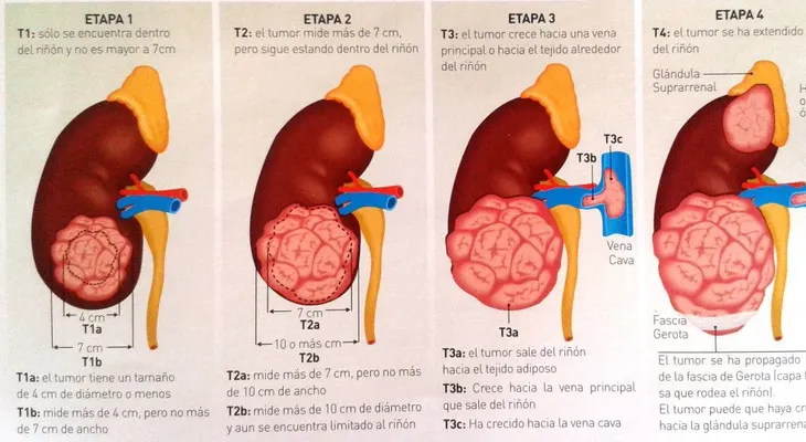 Cáncer de riñón y 10 maneras de reducir el riesgo