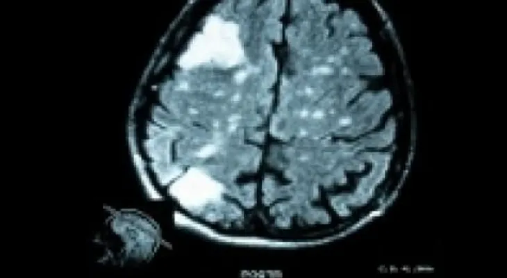 Causas de los tumores cerebrales