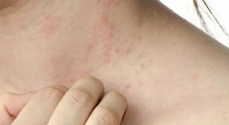 Casos de escabiosis bacteriana empeoran por la escasez de agua y antibióticos