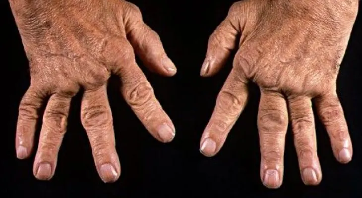 Artritis Reumatoide: Mientras más conocimiento mejor