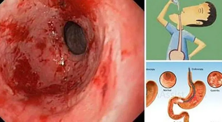 Elimina la acidez y la gastritis de por vida: Solo necesitarás agua de limón, linaza y agua de coco