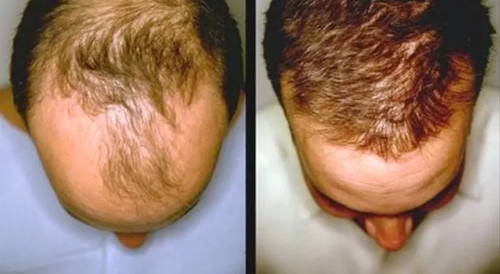 Con estos dos simples pasos puede hacer crecer el cabello naturalmente